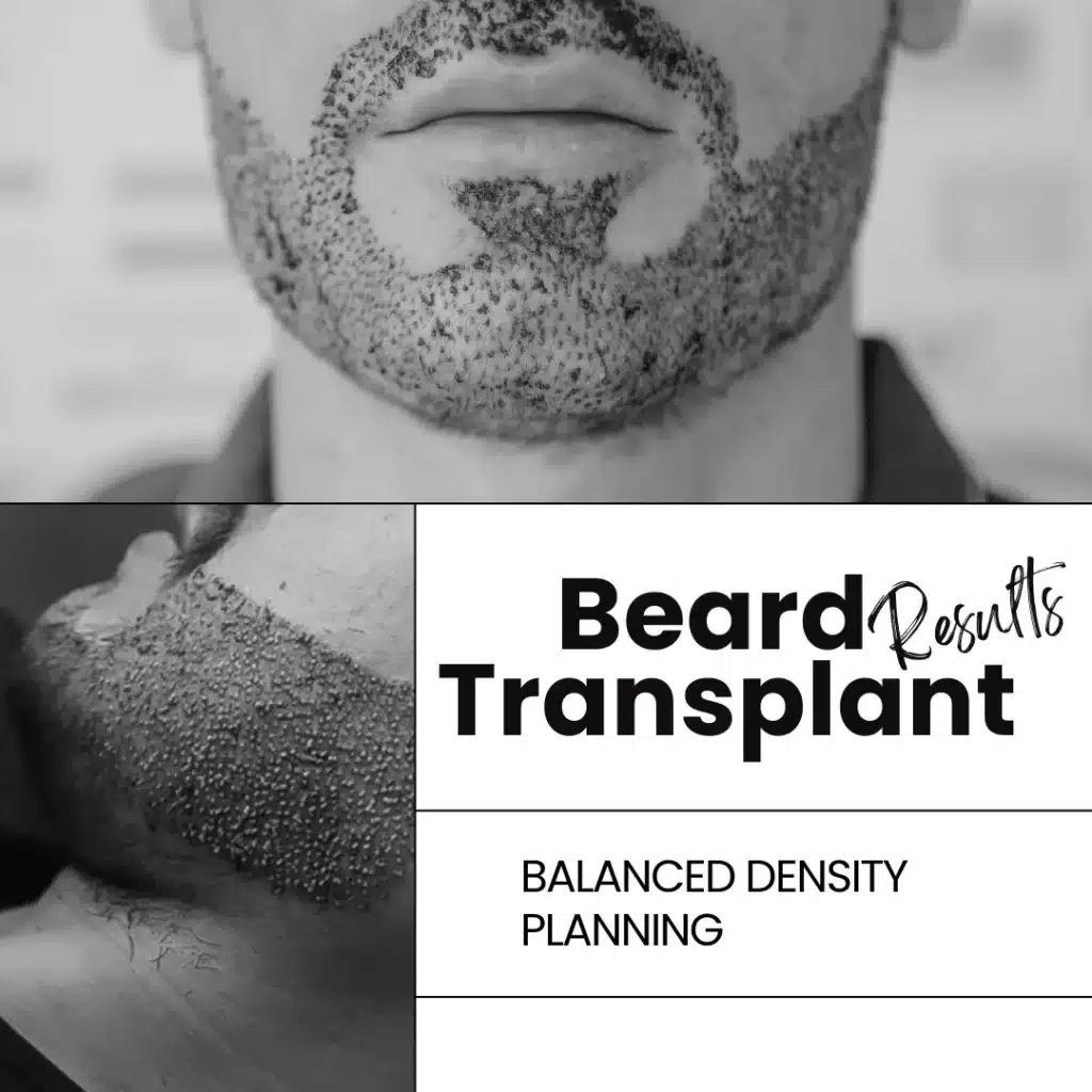Beard Transplant In Turkey – Cost, Before And After 10 Beard Transplant Results Showing Natural Beard Density And Well-Defined Facial Hair Design.