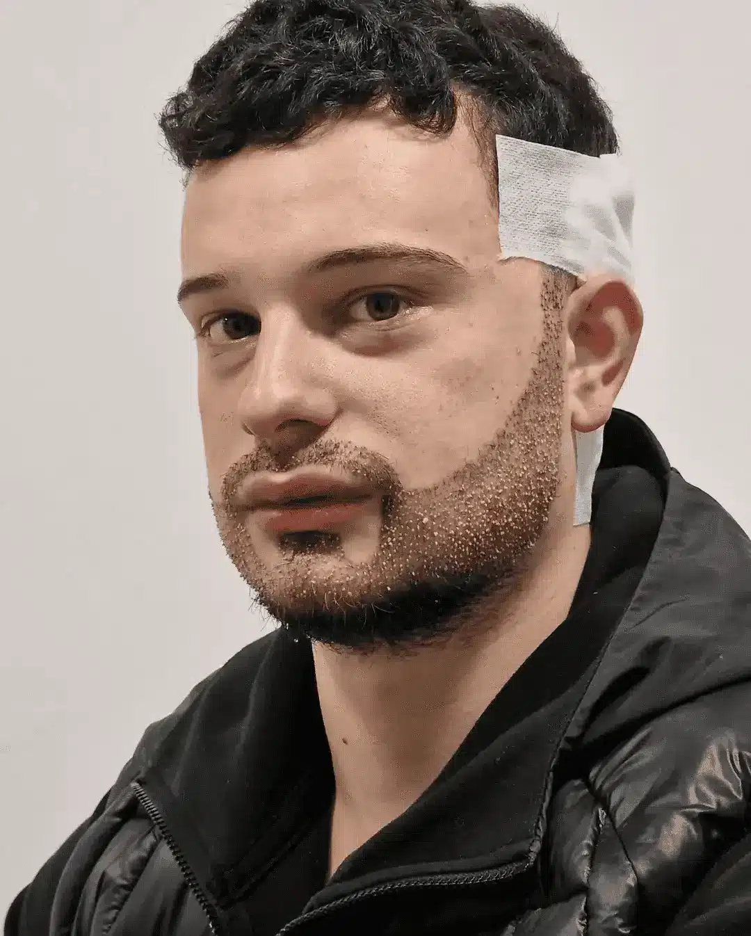 Beard-Hair-Transplant Beard-Mustache Transplant