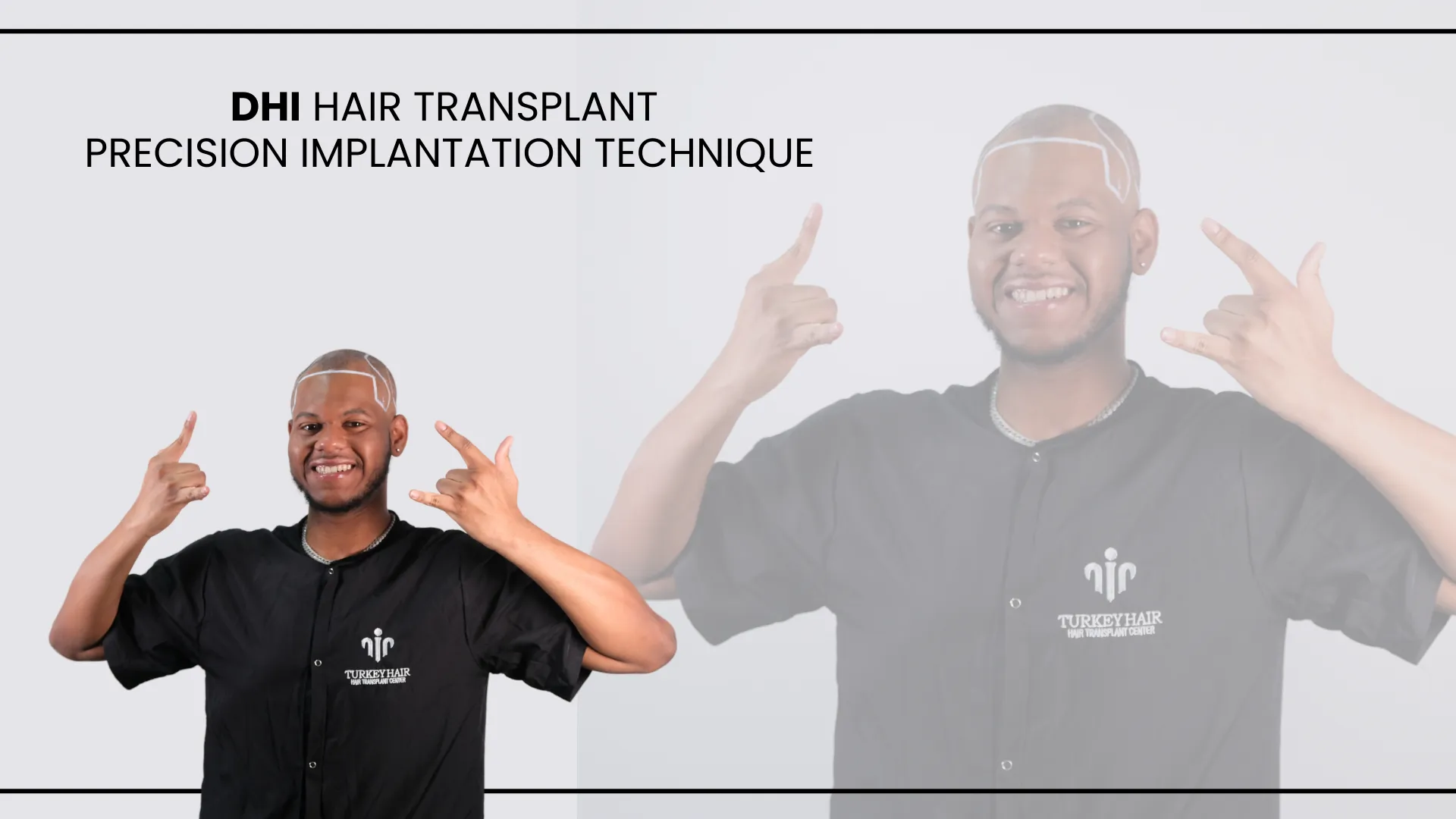 Dhi Hair Transplant 15 Dhi Hair Transplant Why Choose