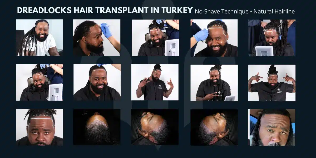 Afro Hair Transplant In Turkey, Cost, Before &Amp; After 16 No Shave Hair Transplant Is A Technique That Allows Hair Transplantation Without Shaving The Donor Or Recipient Area.