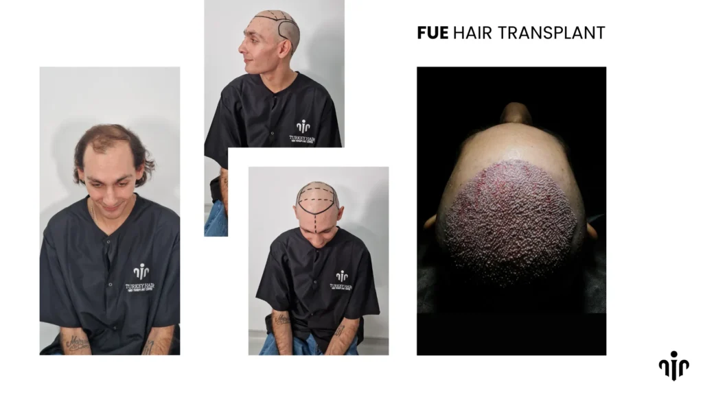 Fue Hair Transplant Is A Modern Technique Where Individual Hair Follicles Are Extracted And Implanted For Natural-Looking Results.