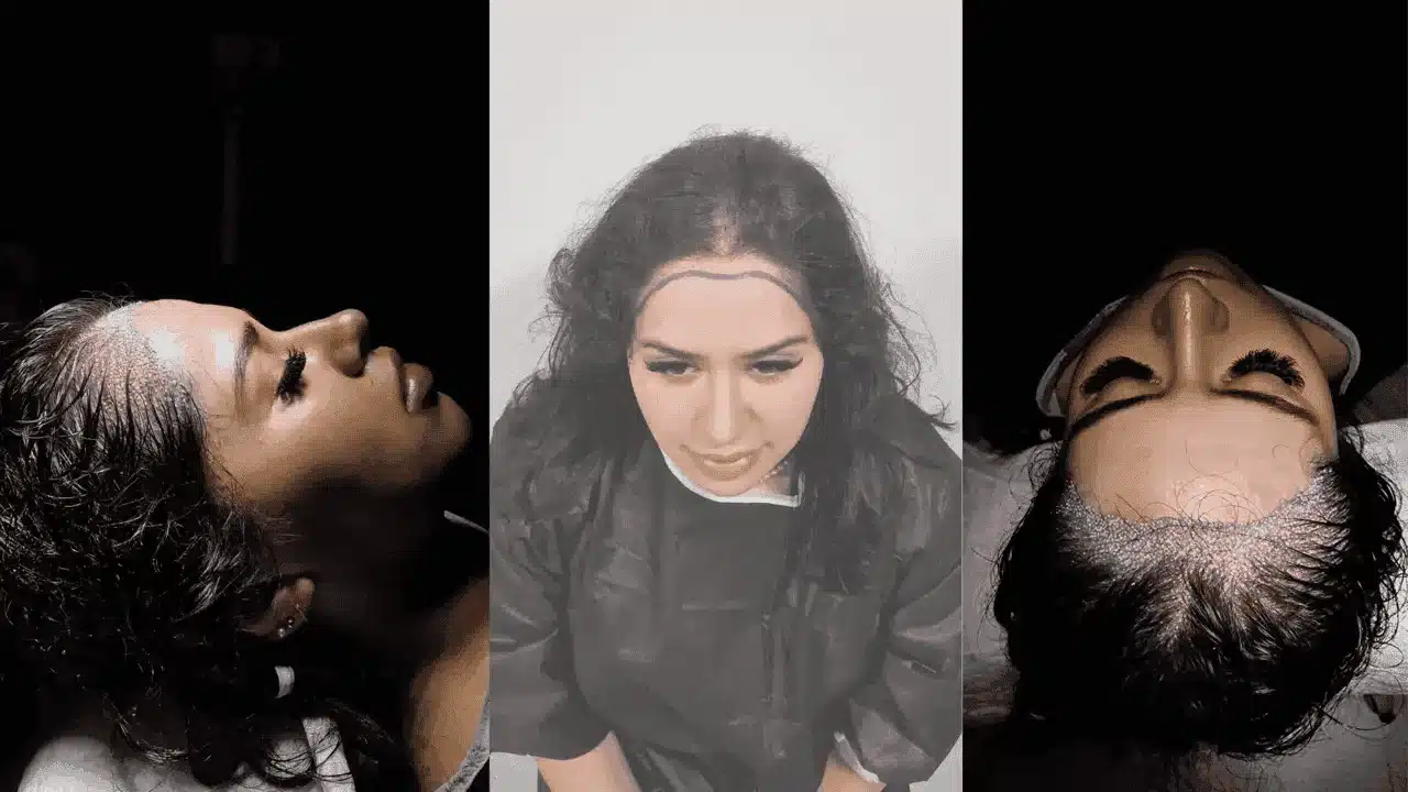 No Shave Hair Transplant 6 Female Hair Transplants No Shave