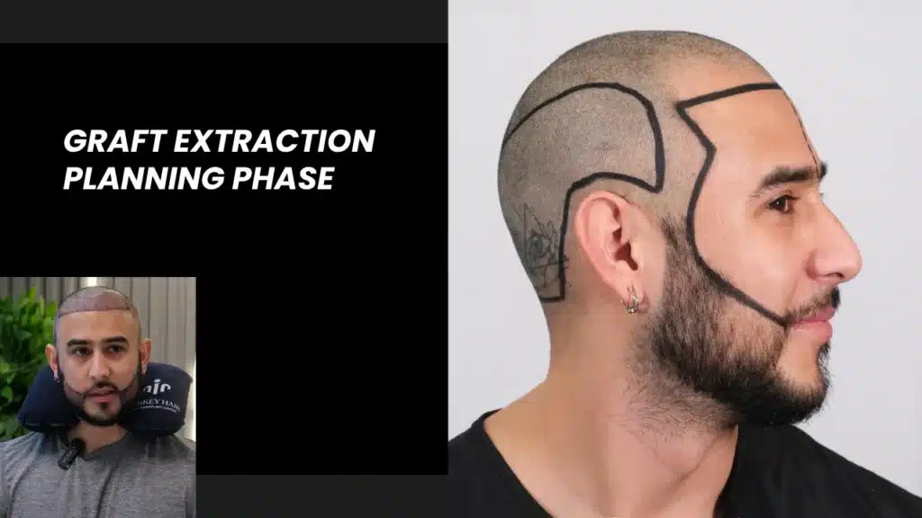 Beard Transplant In Turkey – Cost, Before And After 11 Graft Planning Course Teaches How To Calculate Graft Numbers And Design Natural Hair Transplant Results.