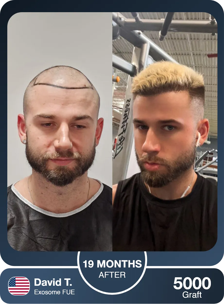 Fue Hair Transplant Before And After Result 2