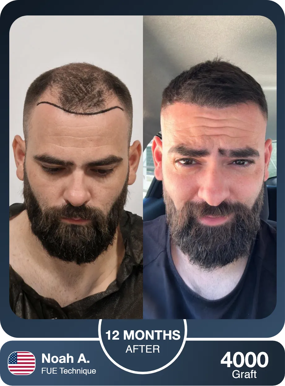 Fue Hair Transplant Before And After Result