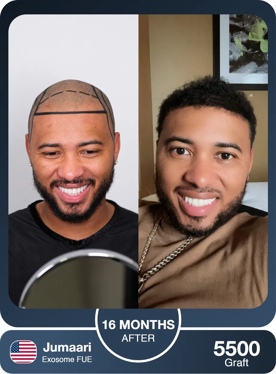 Fue Hair Transplant Before And After Comparison