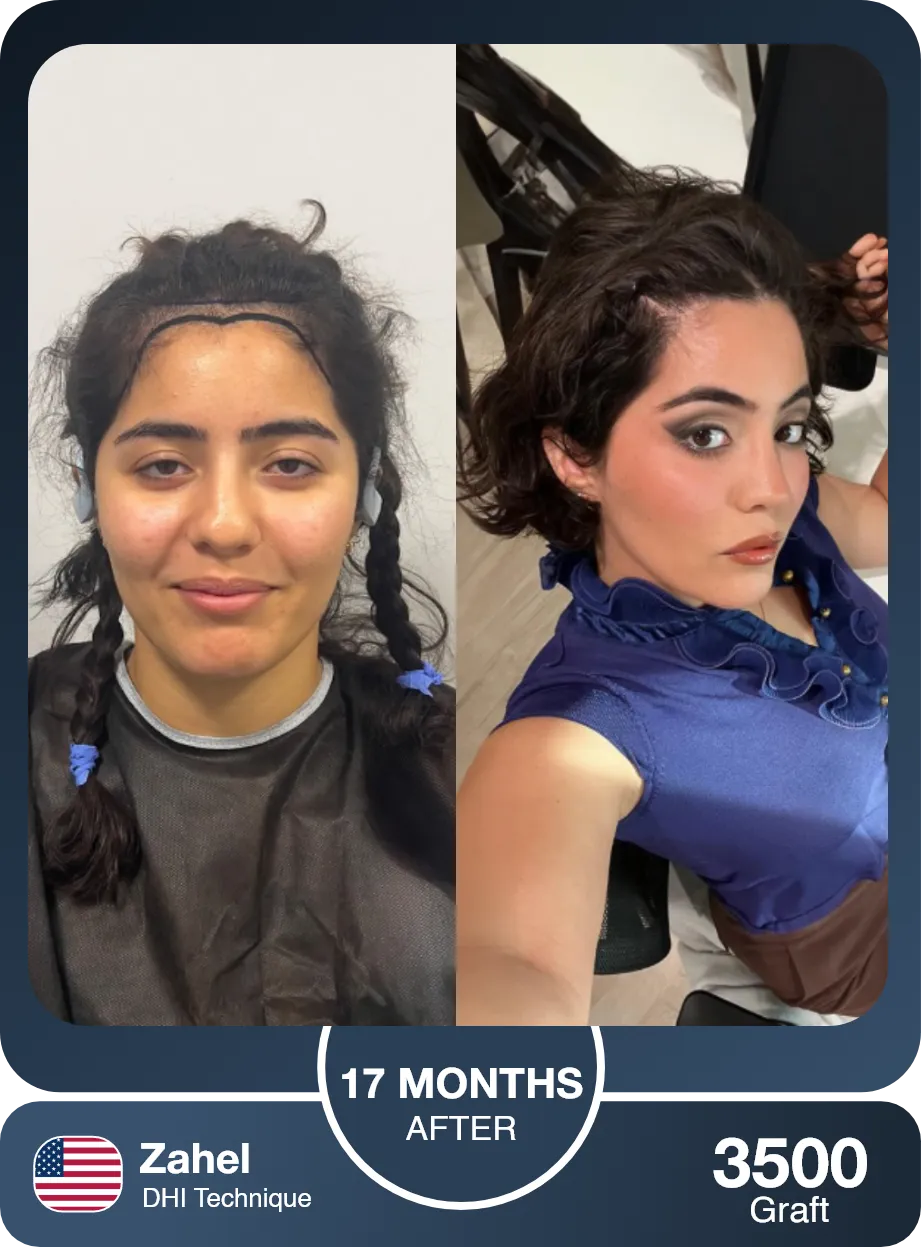 Female Hair Transplant Before And After Result 2