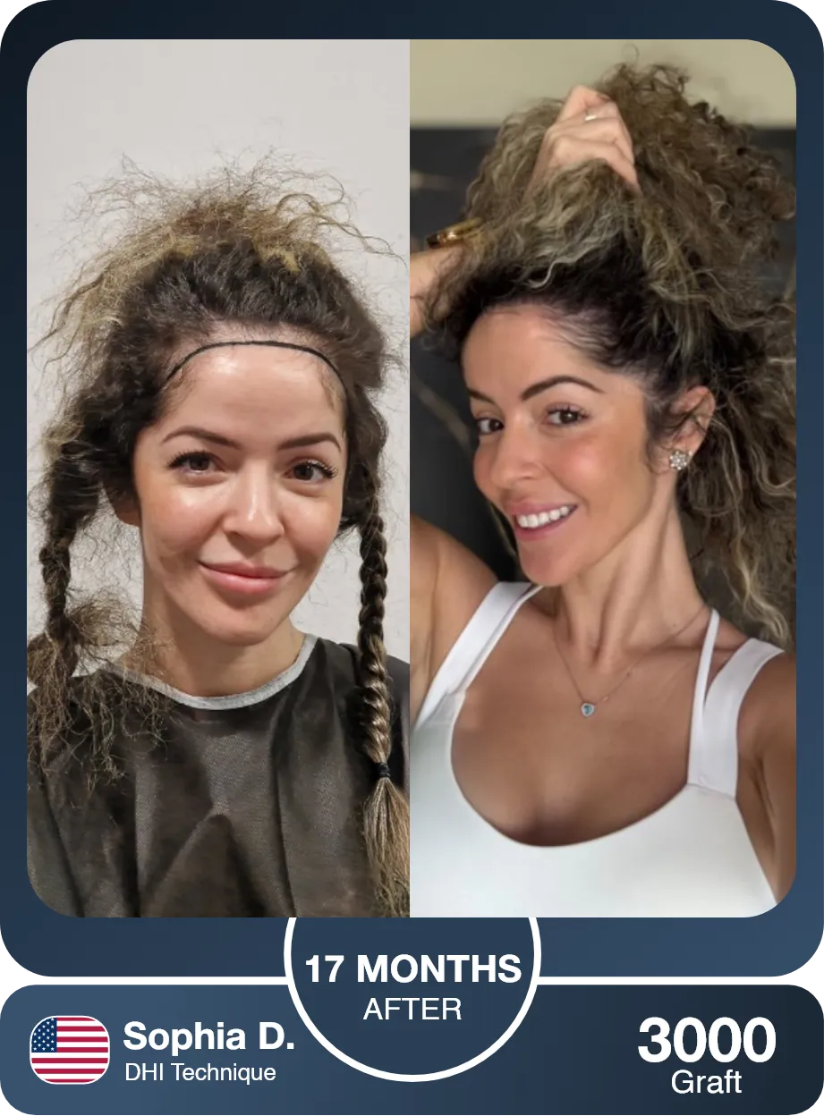 Female Hair Transplant Before And After Comparison