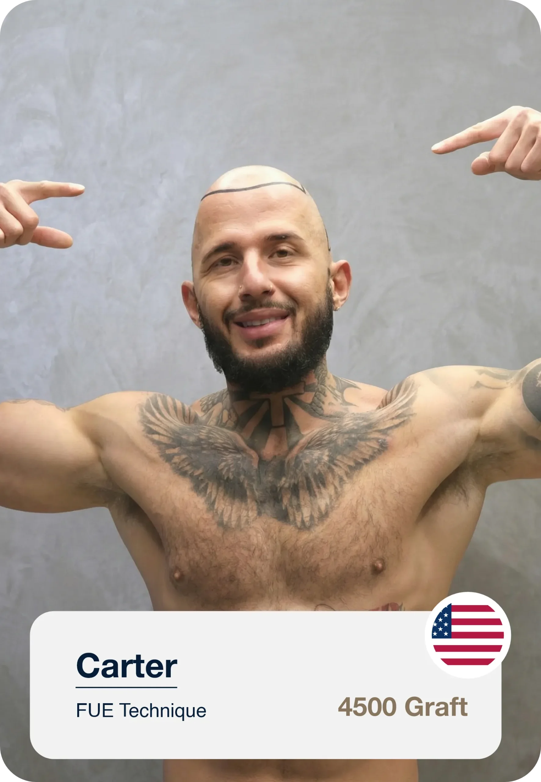 Hairline Marking Process Before Hair Transplant