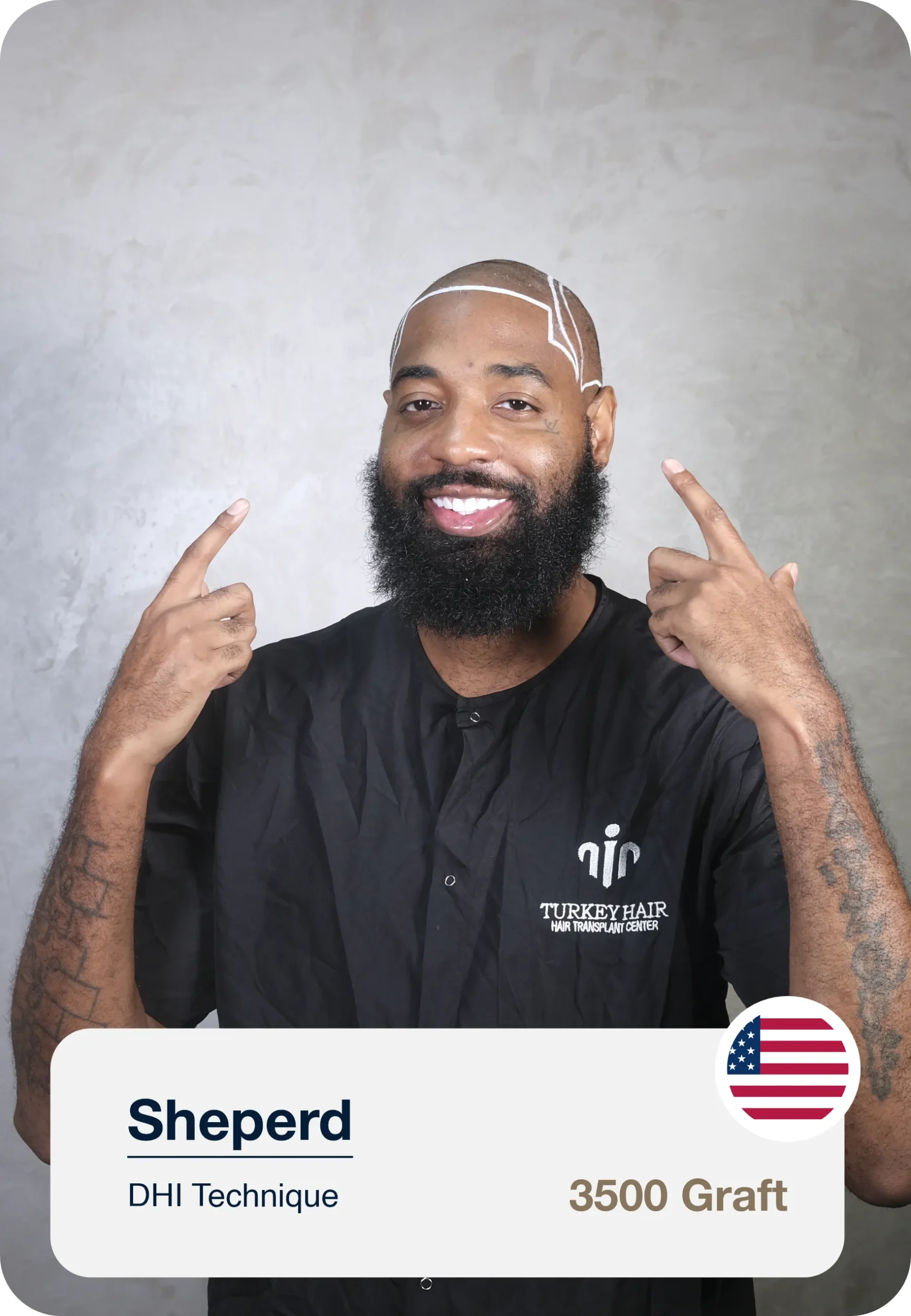 Hairline Marking Process Before Hair Transplant