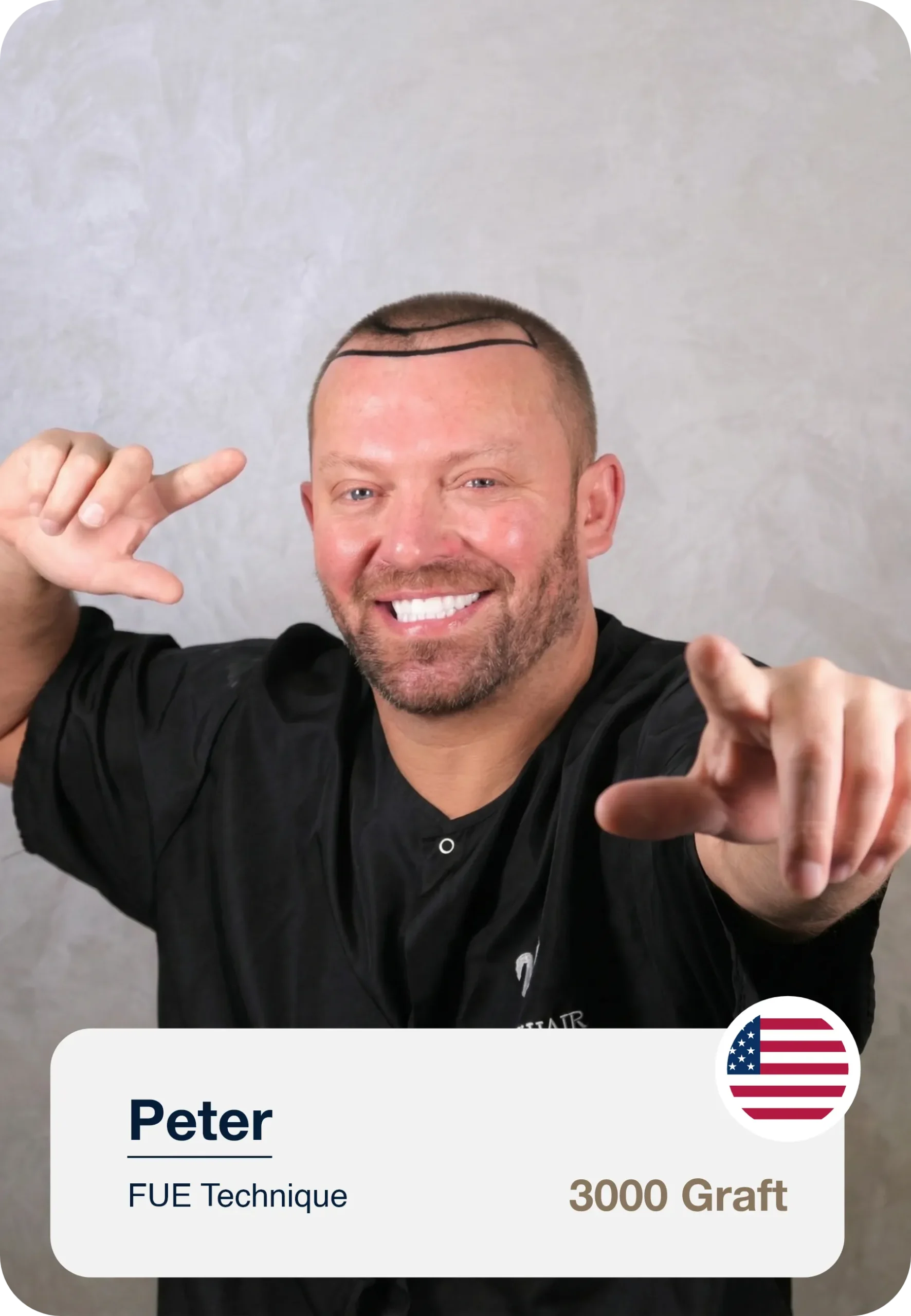 Natural Hairline Design Before Hair Transplant Surgery