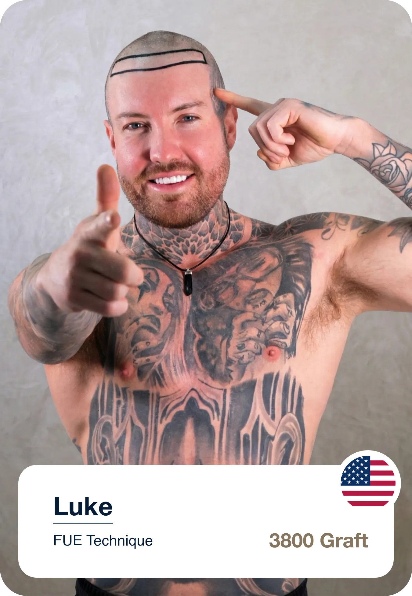 Hair Transplant Consultation With Hairline Drawing