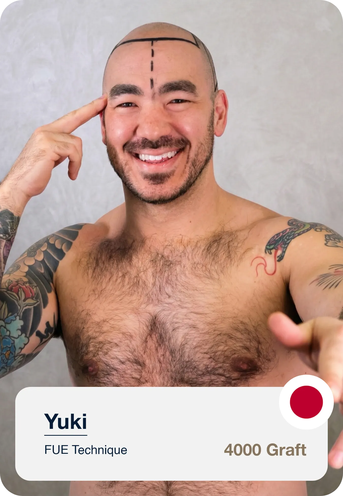 Pre Hair Transplant Hairline Planning On Patient