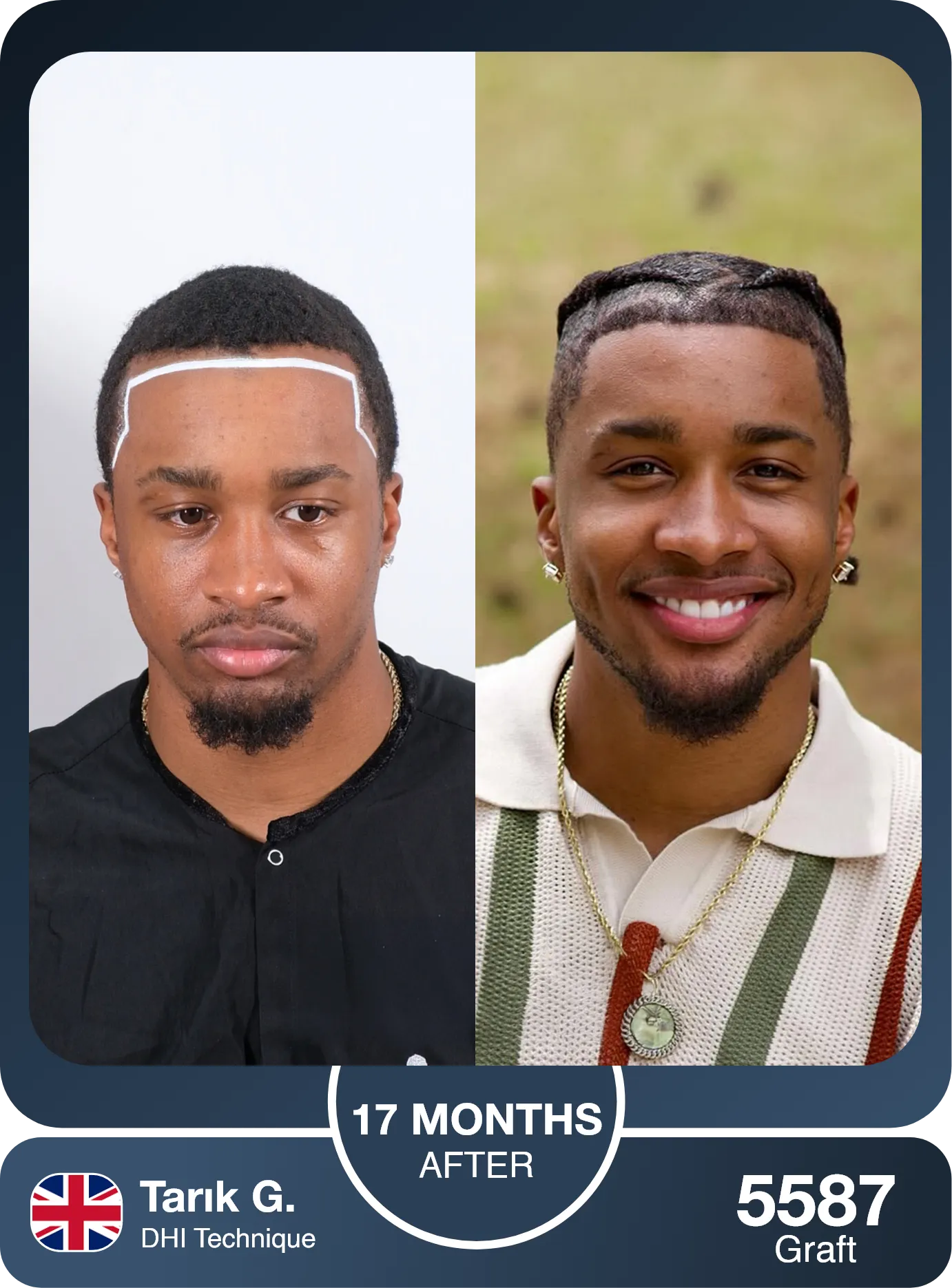 Afro Dhi Hair Transplant Before And After Result