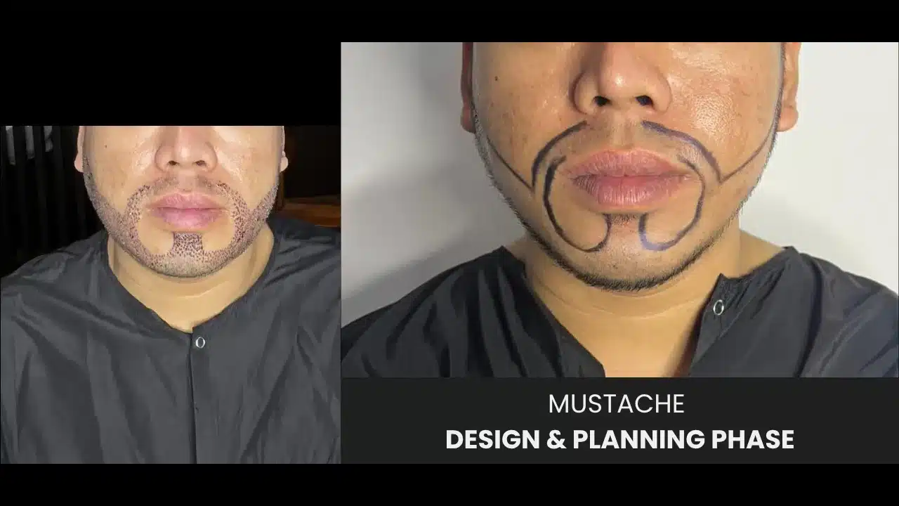 Mustache Transplant 9 Mustache Design Planning
