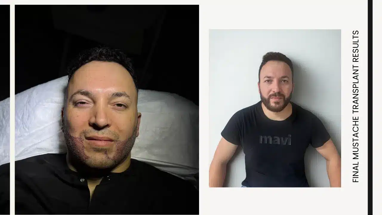 Mustache Transplant 8 Mustache Transplant Before &Amp; And After