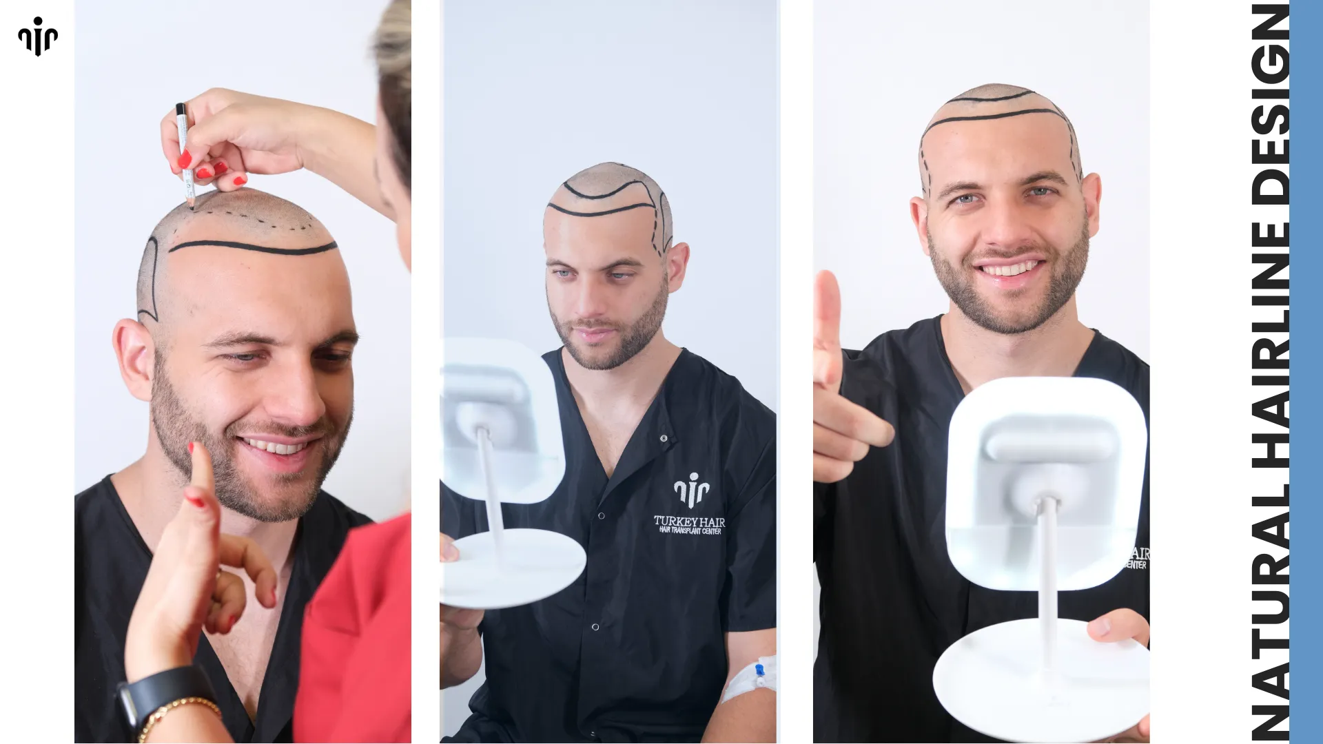 Sapphire Hair Transplant 6 Sapphire Hair Transplant