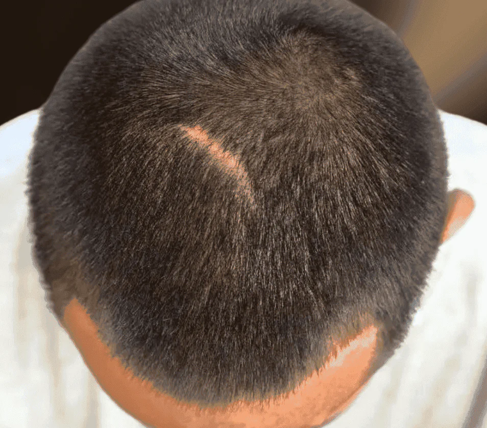 Scar Hair Transplant 6 Fix Scar Hair Transplant