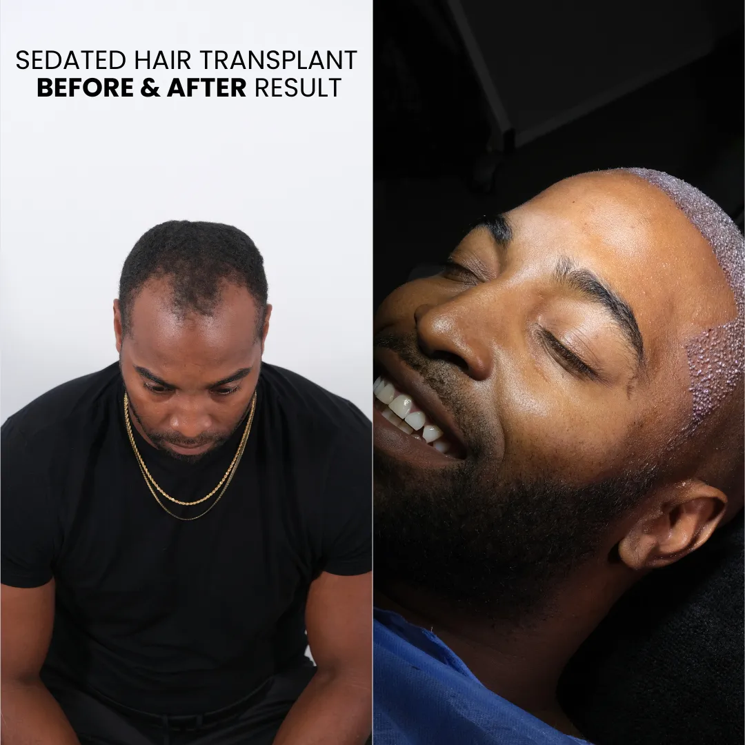 Sedated Hair Transplant 6 Sedated Hair Transplant Before And After