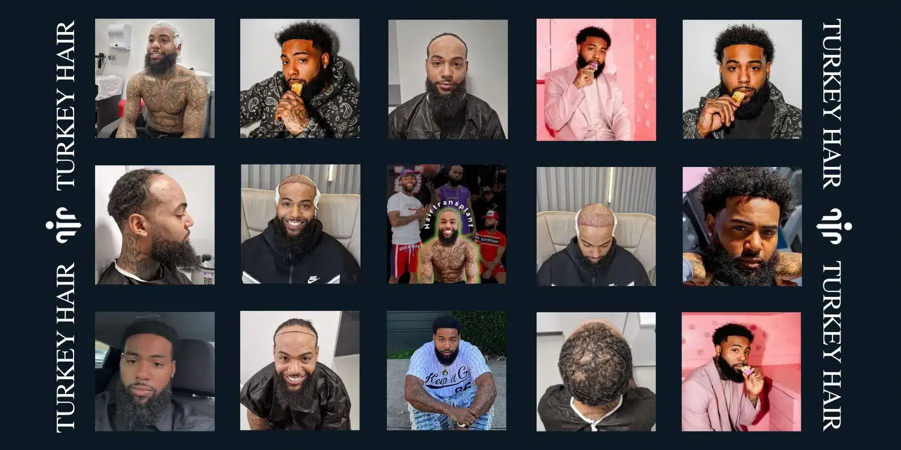 Afro Hair Transplant In Turkey, Cost, Before &Amp; After 19 Begin Your Hair Transplant Journey In Turkey With Expert Care, Advanced Techniques, And A Comfortable Medical Experience.