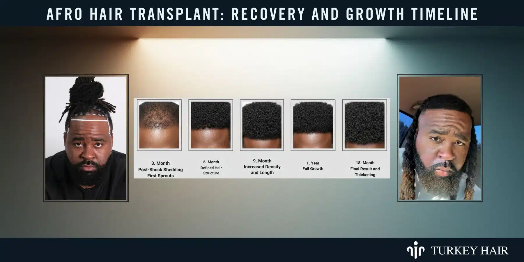 Afro Hair Transplant In Turkey, Cost, Before &Amp; After 13 Understand The Recovery Process And Hair Growth Stages After A Hair Transplant For Optimal Results.
