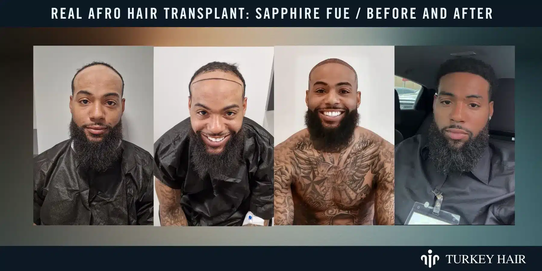 Afro Hair Transplant In Turkey, Cost, Before &Amp; After 15 Sapphire Fue Before And After Results Showing Natural Hairline And Improved Density.