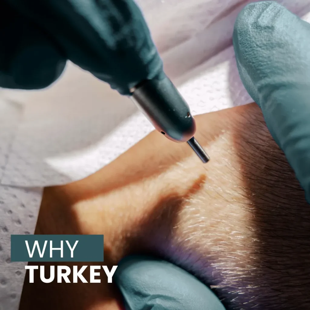 Discover Why Turkey Is A Top Destination For Hair Transplant Procedures.
