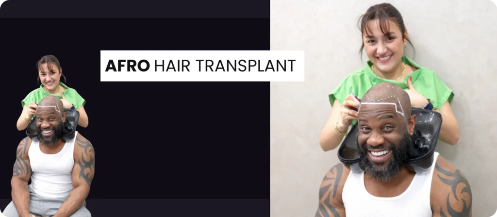 Afro Hair Transplant