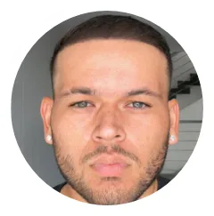 Michael Dhi Hair Transplant Before And After Result 2