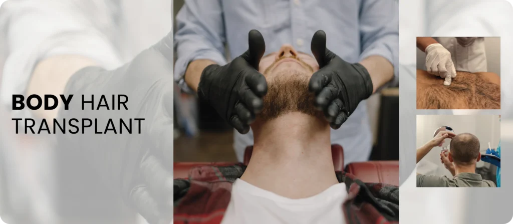 Body Hair Transplant