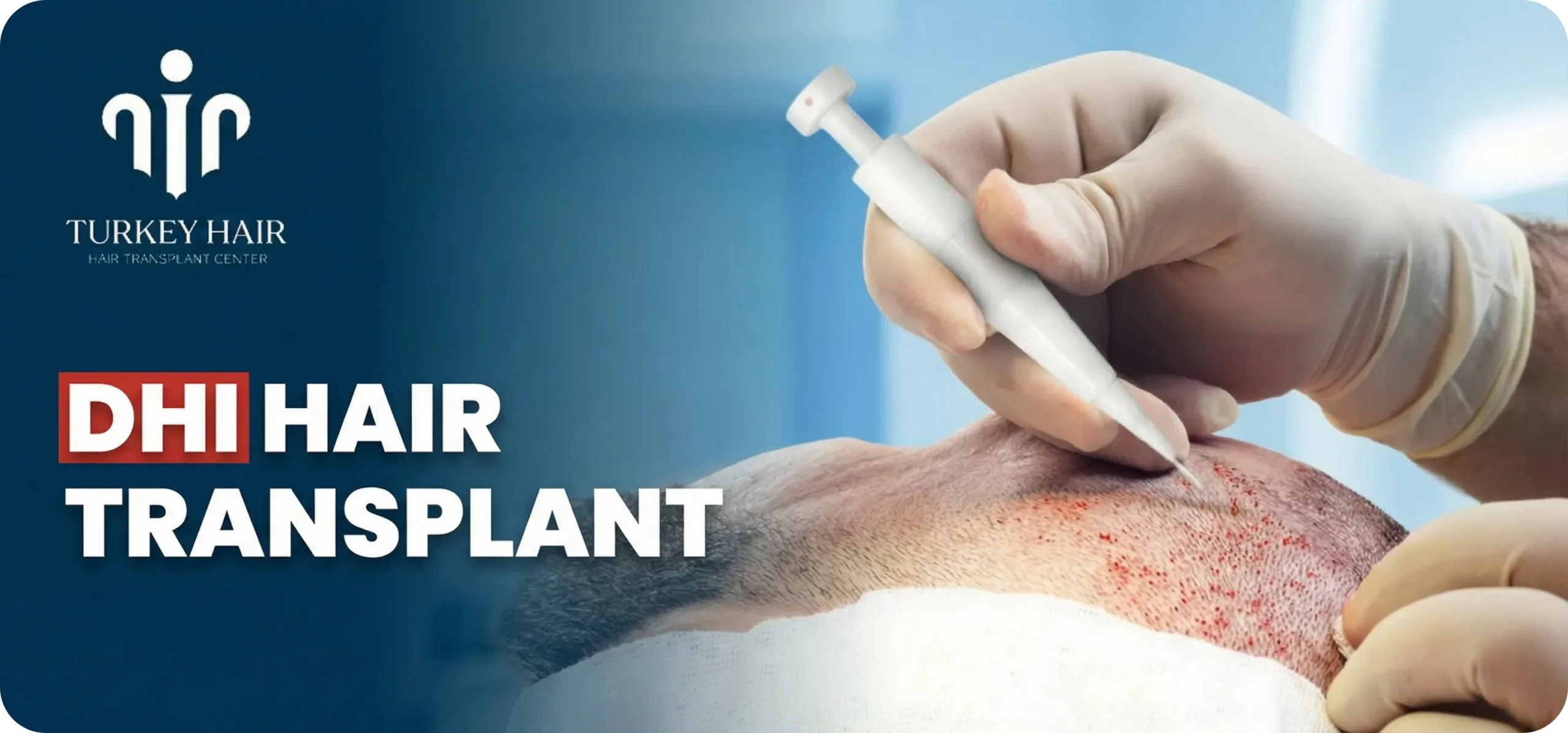 Dhi Hair Transplant in Uganda – Cost, Before & After Hair Restoration Excellence You Can Trust