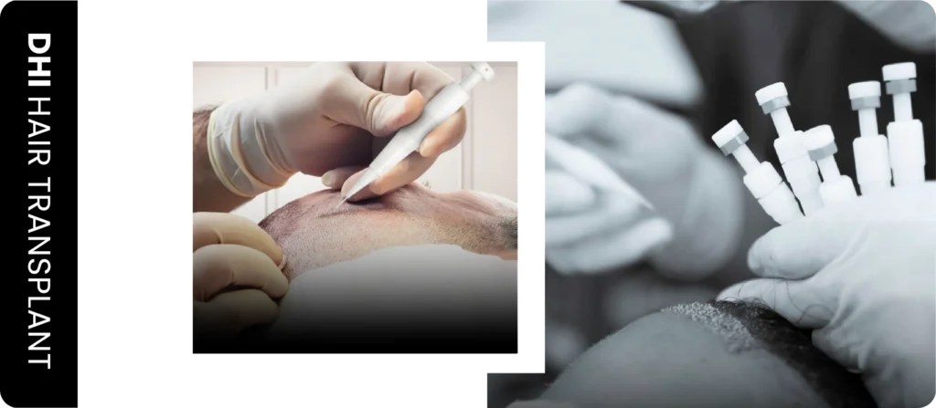 Dhi Hair Transplant Dhi Hair Transplants
