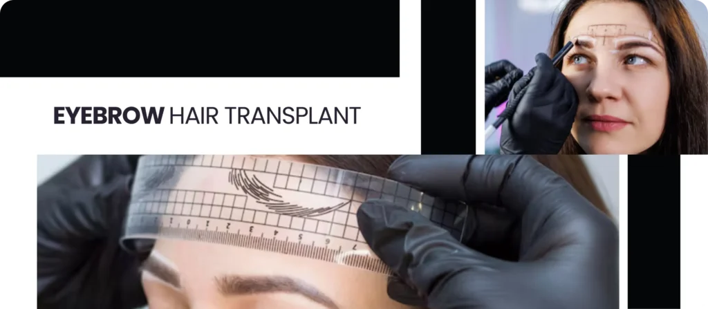 Eyebrow Transplant Eyebrow Transplant