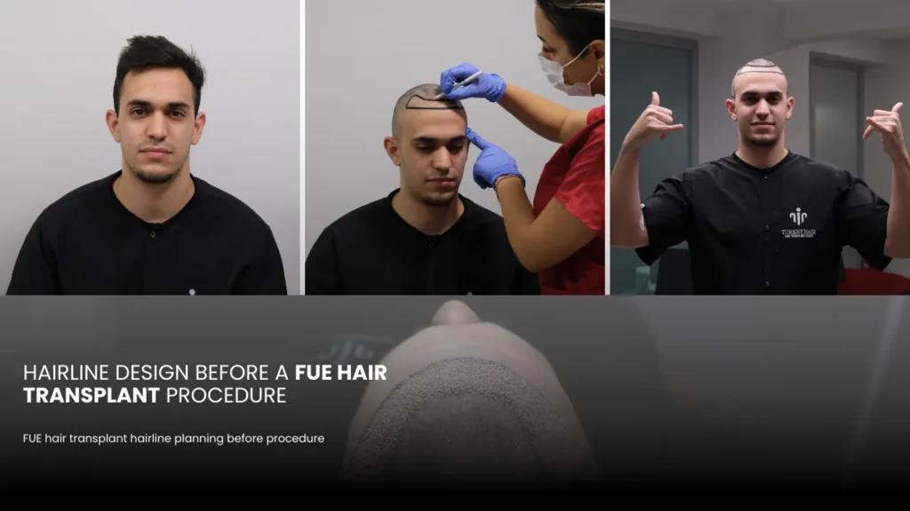 Hairline Design Is The Key To Achieving Natural And Aesthetically Balanced Hair Transplant Results.