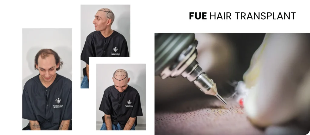 Fue Hair Transplant In Turkey Fue Hair Transplant Procedure In Turkey Natural Results Hair Restoration
