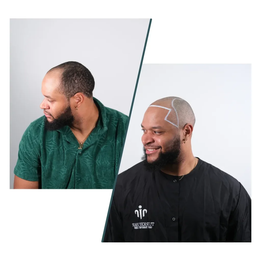 Before Hair Transplant Showing Planned Hairline Design Drawn On The Scalp