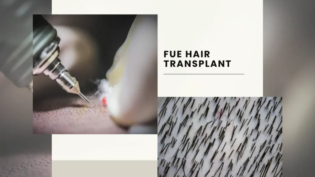 Fue Hair Transplant Technique Involves Precise Extraction Of Individual Follicles For Natural-Looking Hair Restoration.