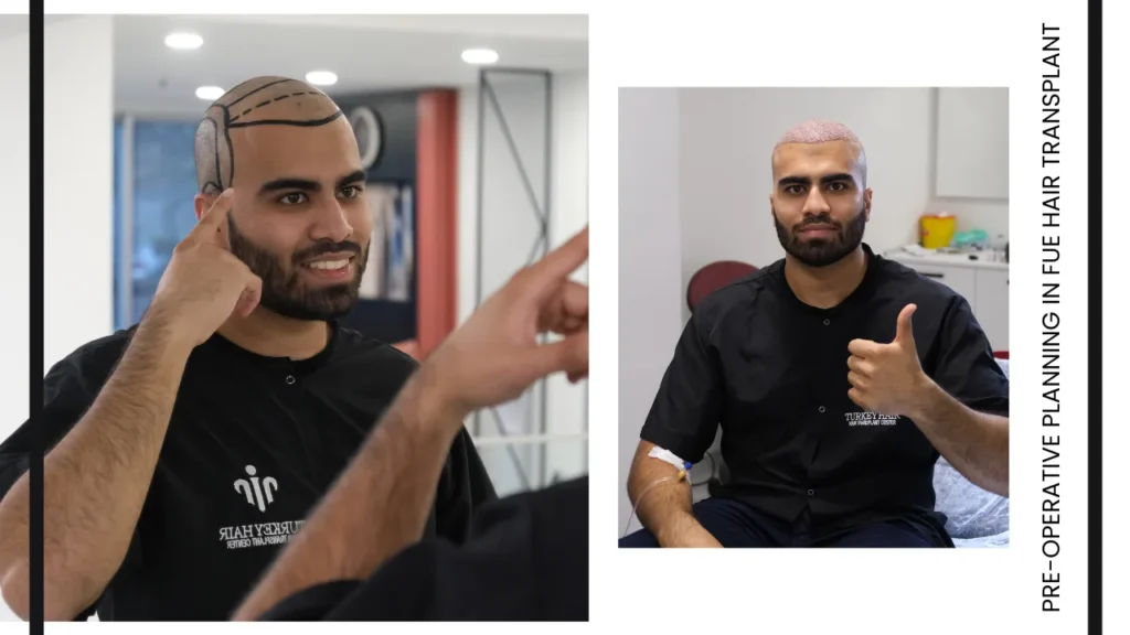 Operation Planning Is A Crucial Step Where The Procedure Is Carefully Designed Based On The Patient’s Needs, Hair Structure, And Desired Results.