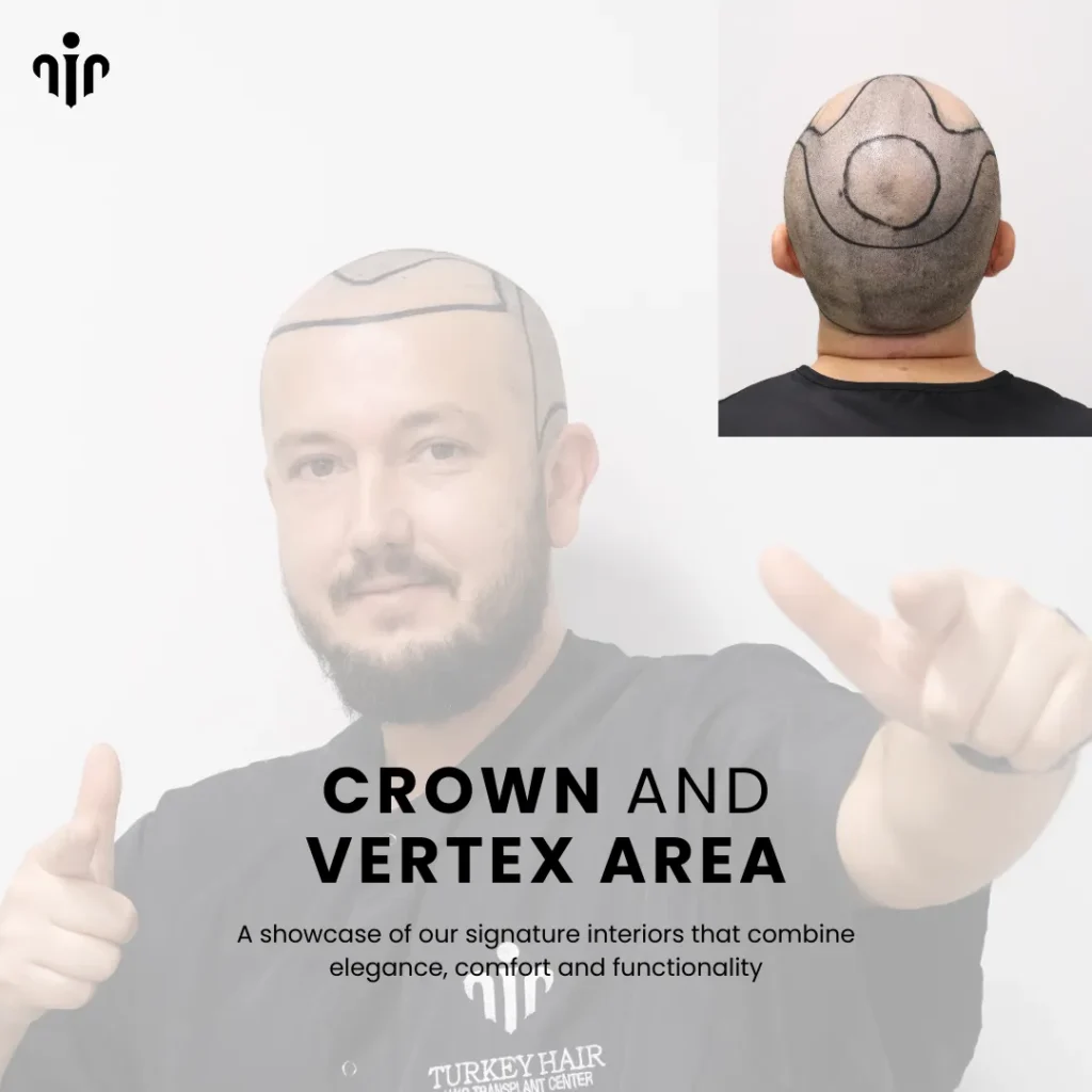 Hair Transplant In The Vertex And Crown Areas Requires Careful Planning For Natural Density And Growth Direction.