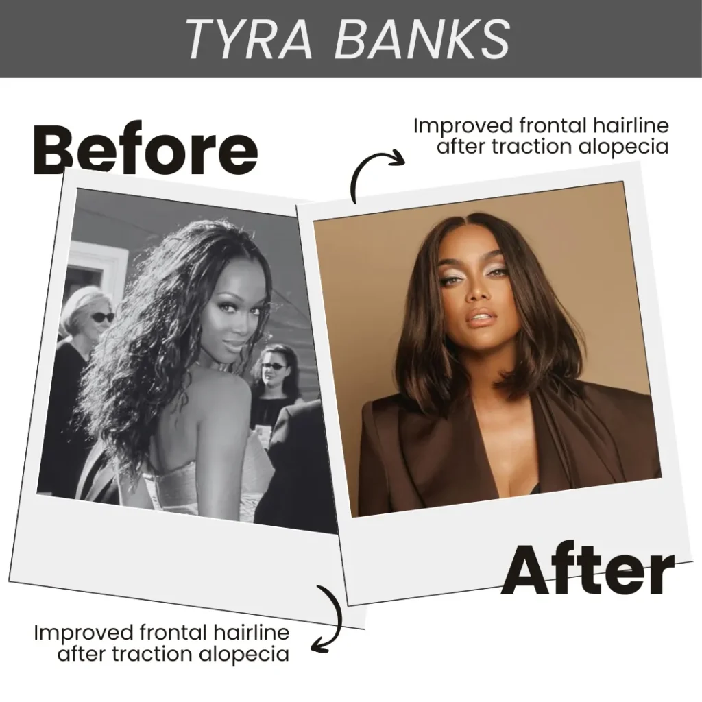 Hair Transplant For Women 14 Tyra Banks Before And After The Hair Transplant