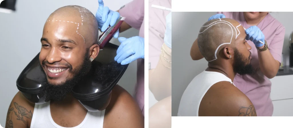 Before Hair Transplant Preparation Hair Transplant Before Procedure Preparation And Consultation