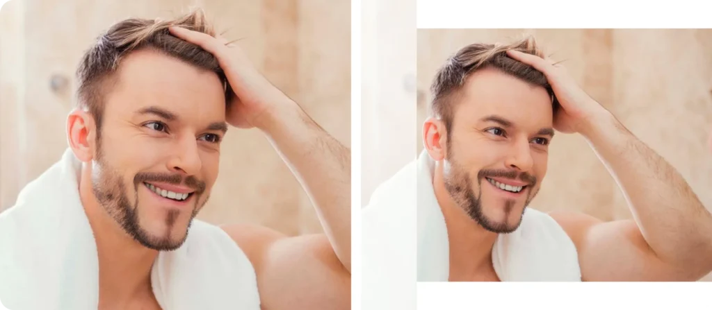 Hair Transplant After Results Hair Transplant After Results Showing Full And Natural Hair