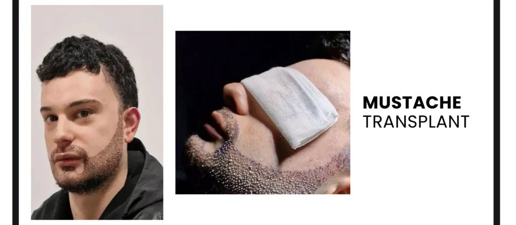 Greffe de moustache à Côte d'Ivoire hair transplant analysis