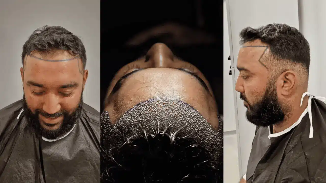 No-Shave-Hair-Transplanr-02 No Shave Hair Transplant Turkey