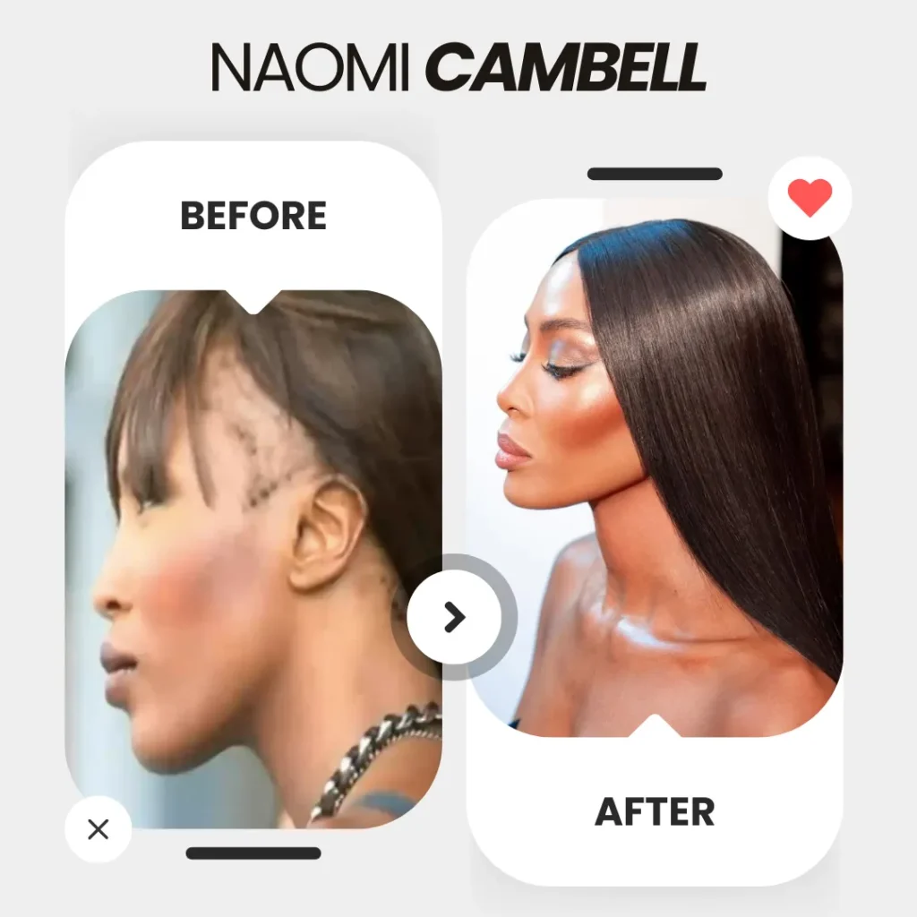 Hair Transplant For Women 12 Naomi Campbell Before And After The Hair Transplant