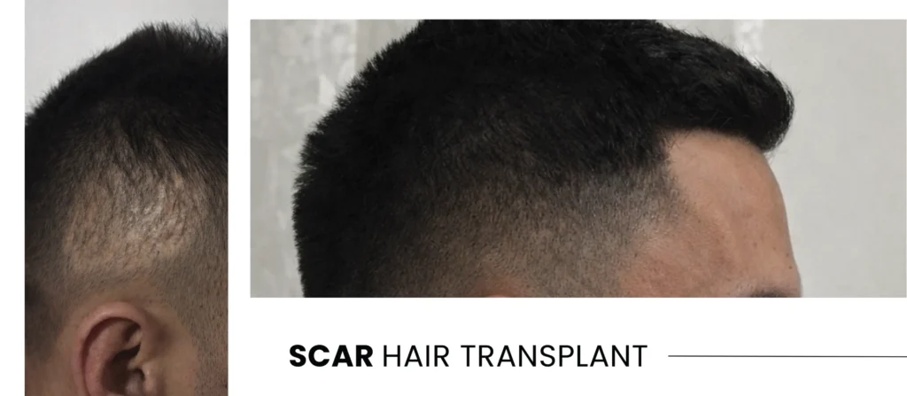 Scar Hair Transplant Scar Hair Transplant