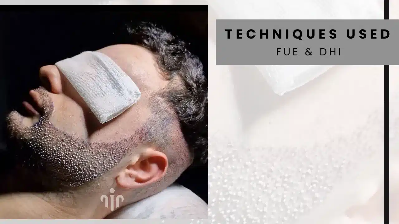 Mustache Transplant 6 Transplantation-Technique