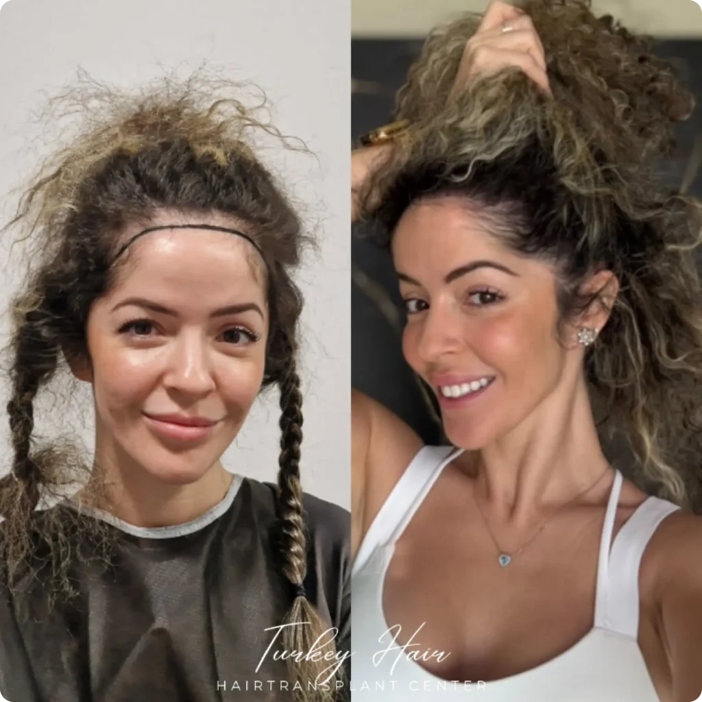 Hair Transplant Natural Results