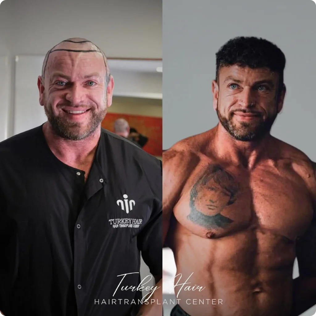 Natural Looking Hair Transplant Outcome