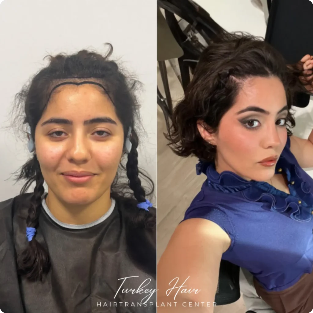 Avant et après la restauration des cheveux féminins montrant une densité accrue et des résultats d'apparence naturelle